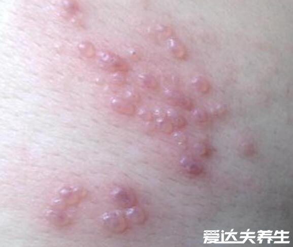 早期带状疱疹图片一侧发病的带状水疱要与全身性水痘区分开