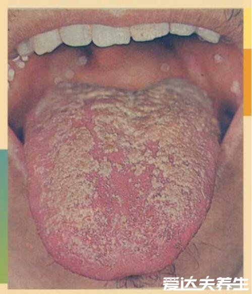 胃癌早期舌头图片,舌头变黑舌苔发黄厚重的可能患胃癌