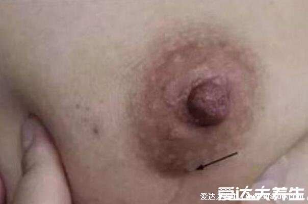 乳腺癌晚期能活多久，乳腺癌早期症状图片