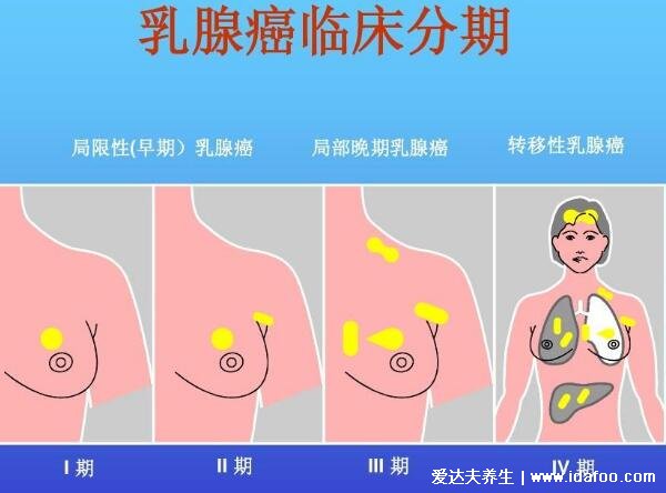 乳腺癌晚期能活多久，乳腺癌早期症状图片