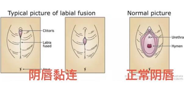 外阴白斑是什么症状图片，皮肤像树皮伴随剧烈的瘙痒灼痛感