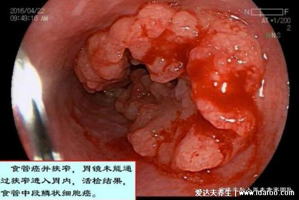 食道癌早期15种征兆，注意食道炎和食道癌最明显区别