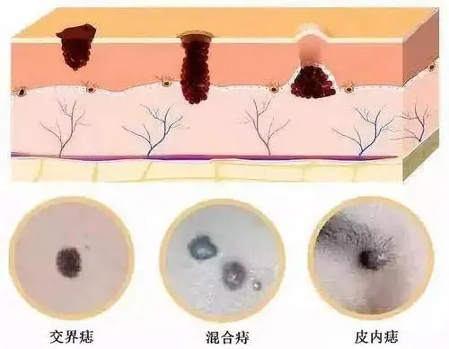 容易癌变的痣的图片早期症状图片，表皮交界痣易恶化(要小心这4种)