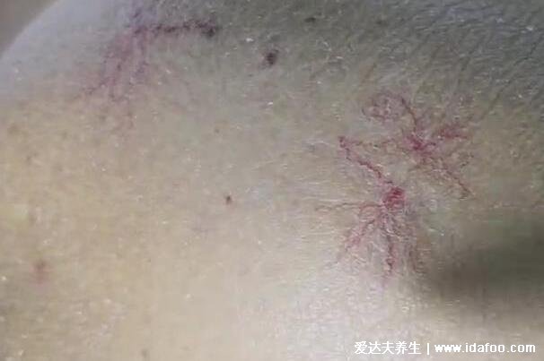 真实肝掌图片初期症状，找准大小鱼际位置按压看颜色(变苍白)