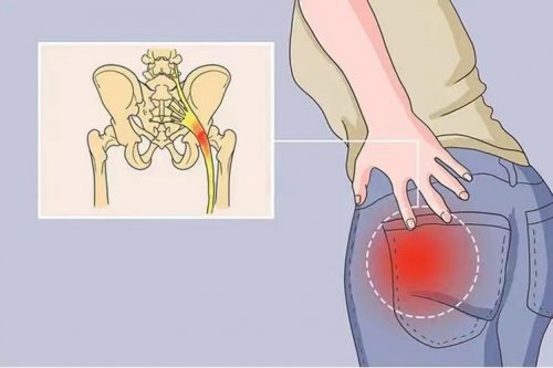坐骨神经痛与梨状肌综合征的康复方法